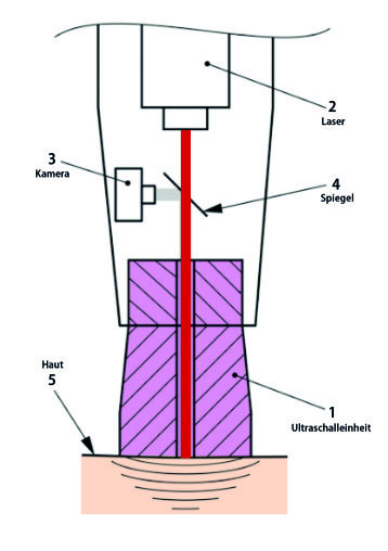 Grafische Darstellung der Ultraschall- und Lasereinheit im Kopf des Behandlungsgerätes.